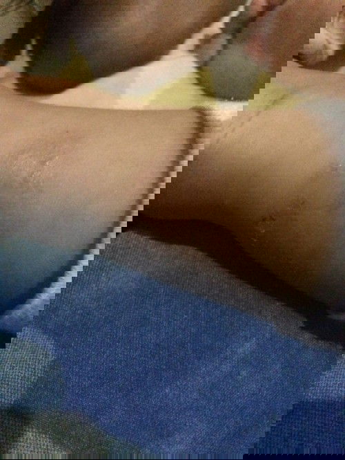 Sakit gatal pada anak