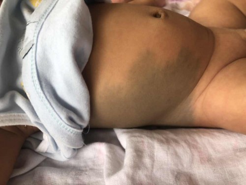 ลูกมีปานแบบนี้ จะหายมั้ยคะ