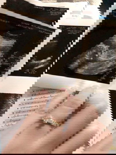 ภาพอันตร้าซาวด์ติน5เดือนใครเป็นแบบนี้บ้างคะ