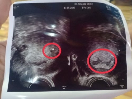 อายุครรภ์กับการตรวจไม่สอดคล้องกัน