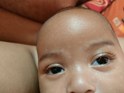 Bercak putih pada wajah bayi