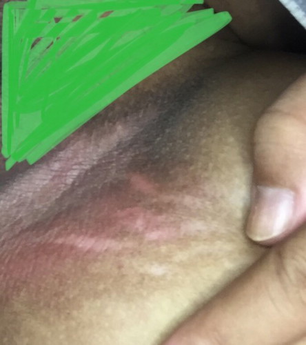 Skin irritation/Stretchmark sa singit