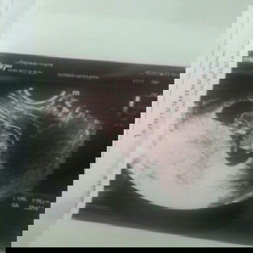 ท้องสองของบ้านอื่น นน.ลูกมากหรือน้อยกว่าท้องแรกกันบ้างค่ะ