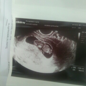 ท้องสองของบ้านอื่น นน.ลูกมากหรือน้อยกว่าท้องแรกกันบ้างค่ะ