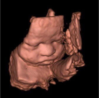 Sempet kepikiran krna bnyak yg bilang hamilny kecil,, bahkan periksa ke bidan pun blg bayinya kecil