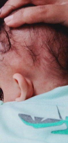 Bun , adakah yg sama di belakang telinga , kepala anak saya ada benjolan tpi lebih dari satu