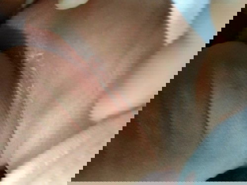 น้องเป็นแผลตรงขาหนีบครา