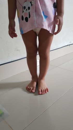 Kaki anak saya kaki X bukan ya?