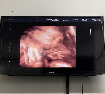 อัลตร้าซาวด์4D ตอนคลอดน้องหน้าเหมือนที่ซาวด์กันมั้ยค่ะ