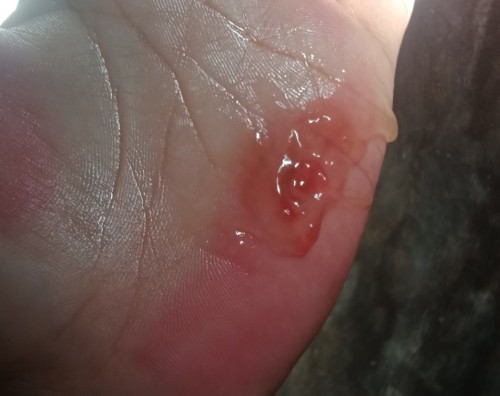 Mucus plug na may halong dugo