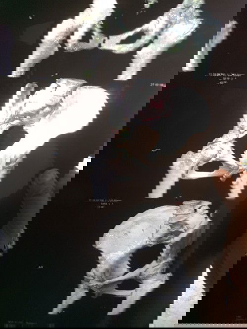 Buat operation replacement hip bone sewaktu mengandung