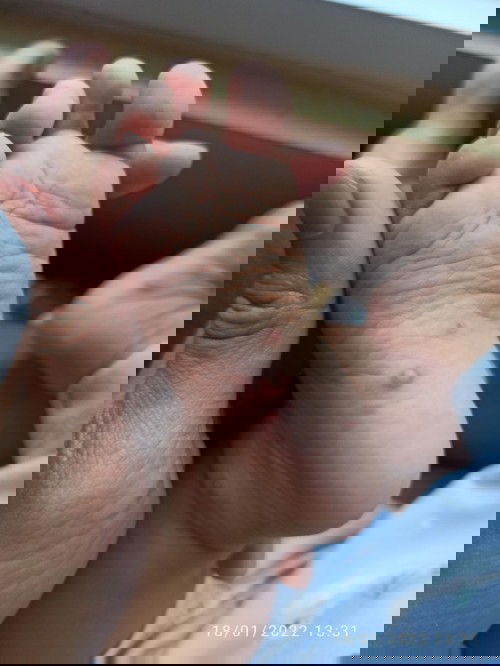 Bentol mirip cacar air