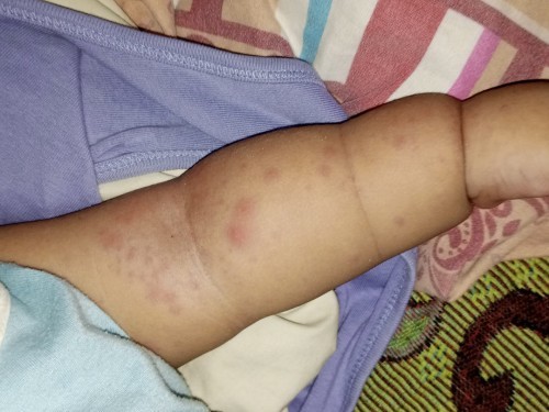 Mga Mami, ano Po kayang tawag Dito na nasa skin mg baby ko? Nag wworried na Kasi ako eh