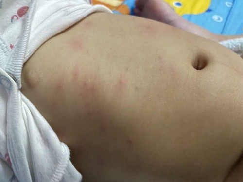 ลูกเป็น ผื่น หรือ แพ้อะไรค่ะ  คุงแม่บ้านไหน เป็นแบบนี้บ้าง