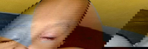 Bintitatn pada anak 3 tahun