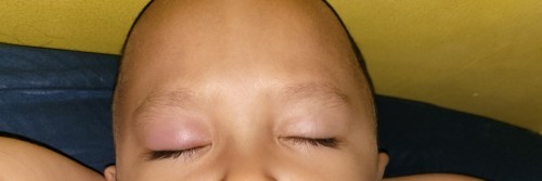 Bintitatn pada anak 3 tahun