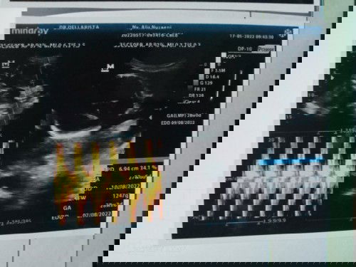 2 kali usg dedenya ngumpet terus jadi belum sempet liat jenis kelaminnya ..