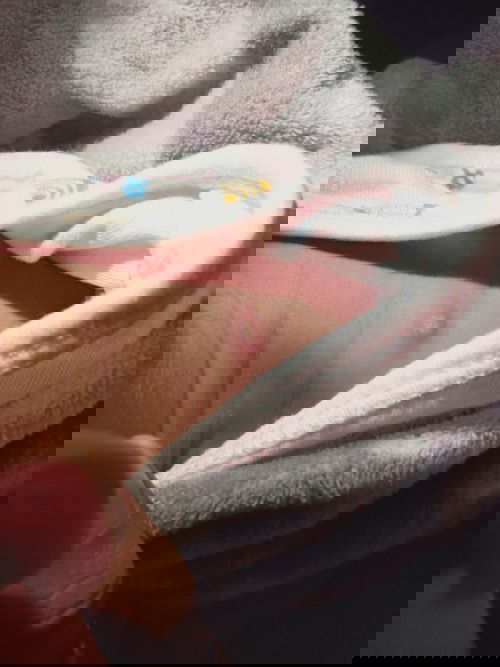 ใช่ฝีดาษไหมคะ??