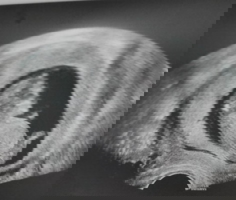 Ultrasound Picture