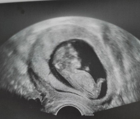 Ultrasound Picture