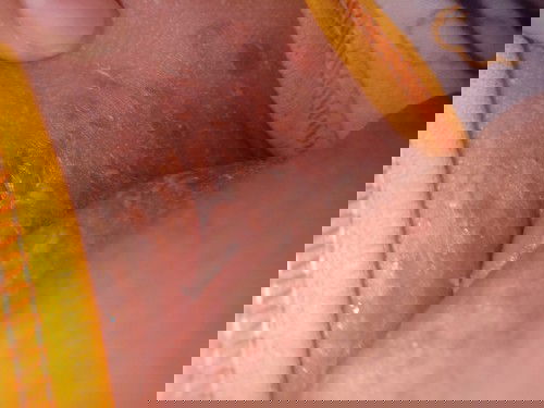 Leher merah merah mengelupas seprrti melepuh