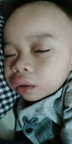 Biglaang pamamaga ng labi