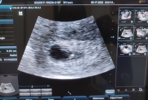 Hi! Eto po latest TVS scan ko. Ask lang sana, normal po ba na wala akong symptoms na nararamdaman?