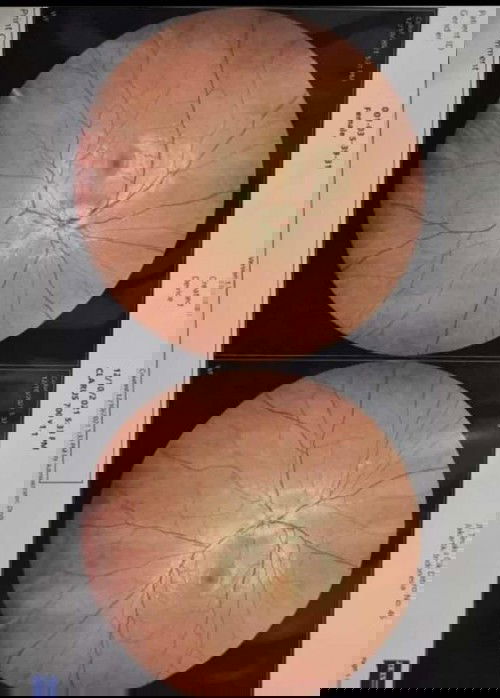 Papiledema pada usia kehamilan 6 Minggu 