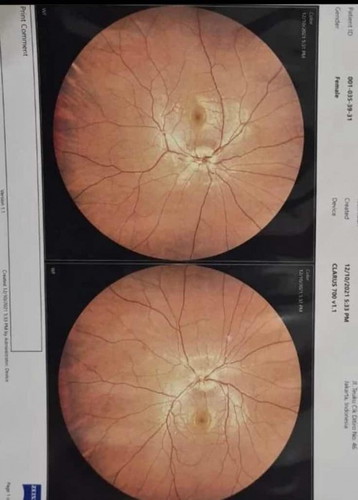 Papiledema pada usia kehamilan 6 Minggu