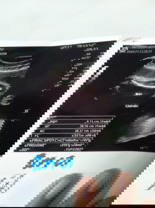 อยากทราบว่ากำหนดคลอดควรยึดจาก ปจด ขาด หรือ ใบอัลตร้าซาวด์