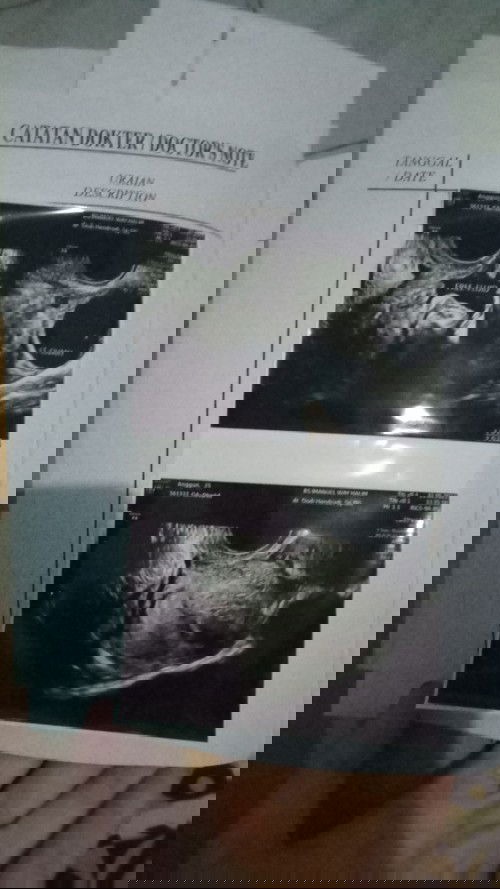 Usg belum terlihat janin