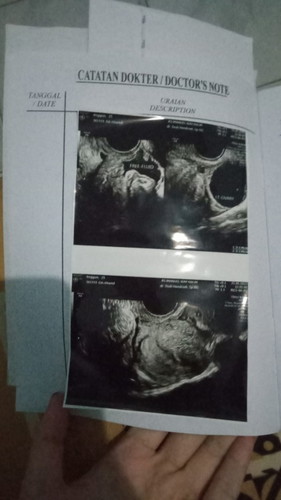 Usg belum terlihat janin