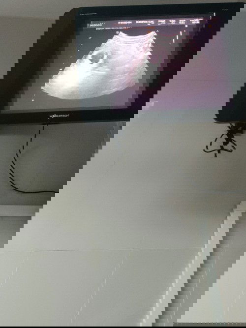 คุณแม่ตั้งครรภ์กี่เดือนค่ะถึงเจอน้องในถุงตั้งครรภ์