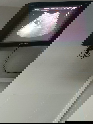 คุณแม่ตั้งครรภ์กี่เดือนค่ะถึงเจอน้องในถุงตั้งครรภ์