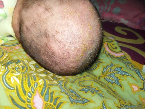 Kepala bayi bernanah