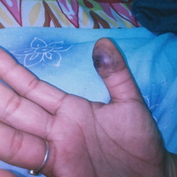 Nmaga po ang kamay wla ng nana naalis kona kaya lng my nabuo dugo sa loob.