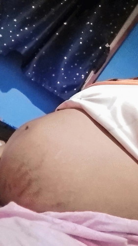 มีแม่บ้านไหนท้องแตกลายมั้งคะพอจะแนะนํ้ายาหรือครีมอะไรได้บ้างคะตอนนี้ท้องได้34+4วิค
ขอบคุณล่วงหน้าค่ะ