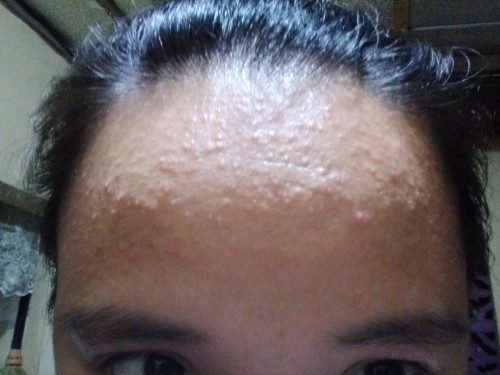 Tigyawat or dahil sa hormones