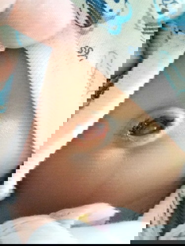 สะดือลูกมีเลือดออกค่ะ