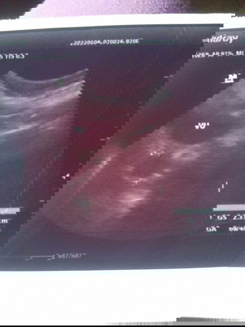 Hasil usg 6week emang masih belum nampak janin ?