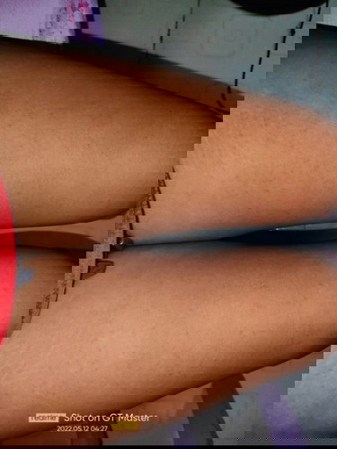 Allergy ba ito? Anong magandang sabon at lotion ang pedeng gamitin? Nakakabother na kasi😢