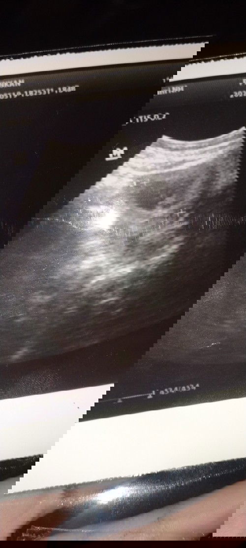 Kemarin saya USG udah 10weeks3day tapi kok janinya masih bentuk nya bulat doang ya Bun?