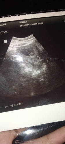 Kemarin saya USG udah 10weeks3day tapi kok janinya masih bentuk nya bulat doang ya Bun?