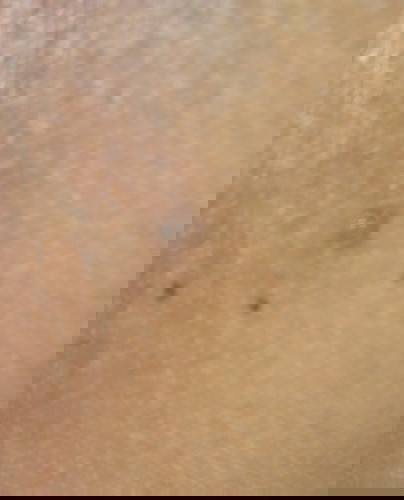 Genital warts po ba ito?