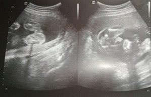 Gender ultrasound
