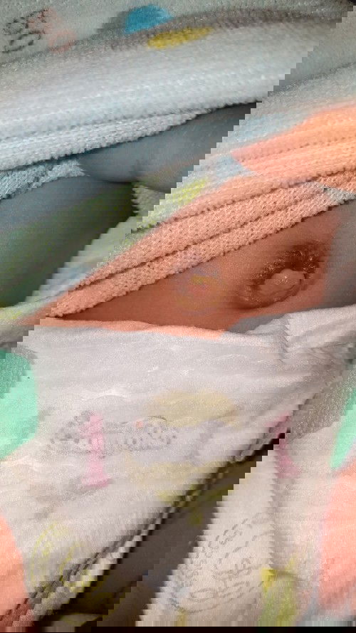 สะดือลูกแบบนี้เรียกติดเชื้อหรือป่าว ไม่มีกลิ่นเหม็นนะคะควรไปหาหมอไหม