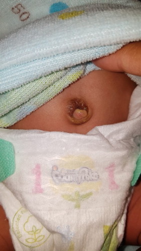 สะดือลูกแบบนี้เรียกติดเชื้อหรือป่าว ไม่มีกลิ่นเหม็นนะคะควรไปหาหมอไหม