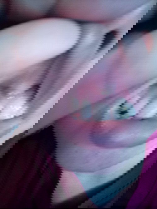 Anong dpat kong gwin may nana po kc ang gums ng ngipin ko, lumalaki po sya😭nkaumbok na ang bibig ko