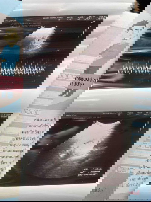 แม่มีโรคประจำตัวไทรอยด์เป็นพิษ แม่ๆบ้านไหนเป็นเหมือนกันบ้างคะ แชร์ประสบการณ์หน่อยค่ะ