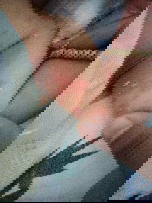 Da bé nổi bọng nước có mủ